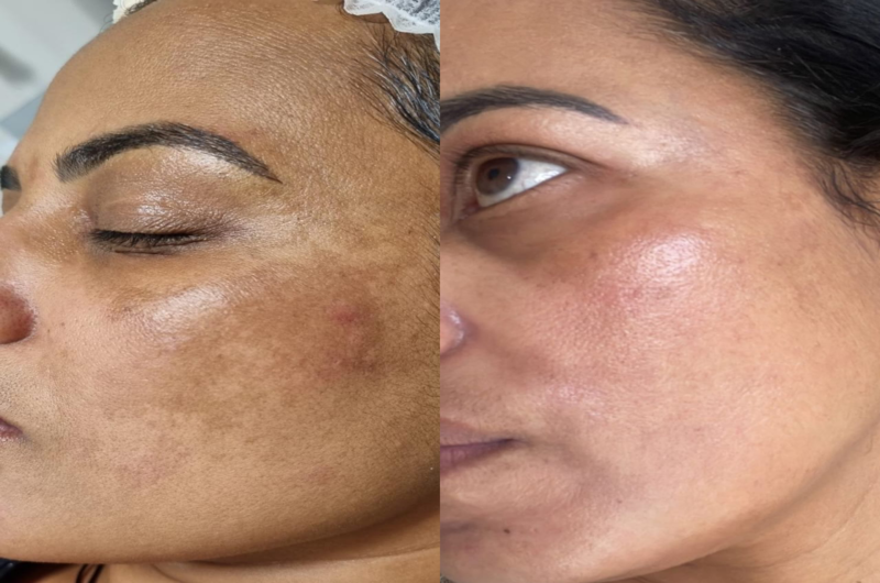 Gerenciamento de Melasma